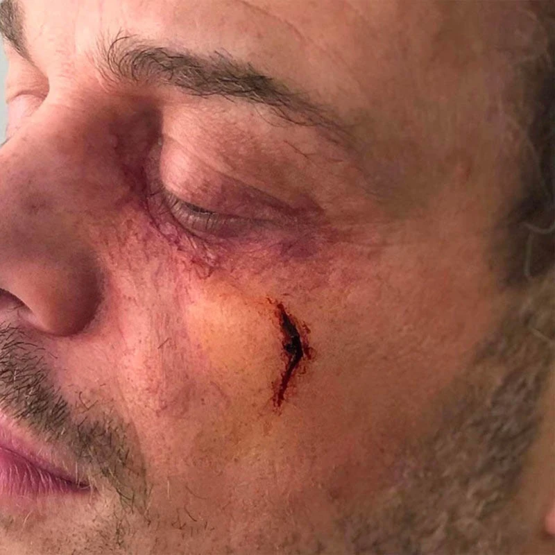 OCCHIO GONFIO Sinistro 2 OCCHIO GONFIO Sinistro - immagine 2