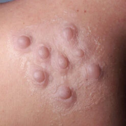 PROSTESI PUSTOLE IN SILICONE -Trucco Di Halloween 800x800 stupr3152 prostesi pustole in silicone 3