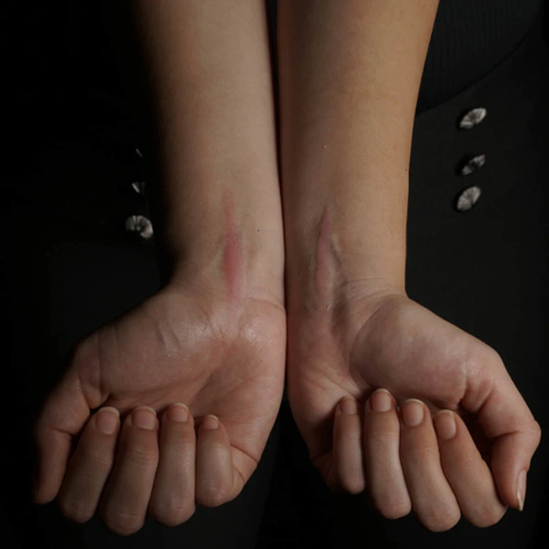 PROTESI SET CICATRICI CHELOIDI 2 PROTESI SET CICATRICI CHELOIDI - immagine 2