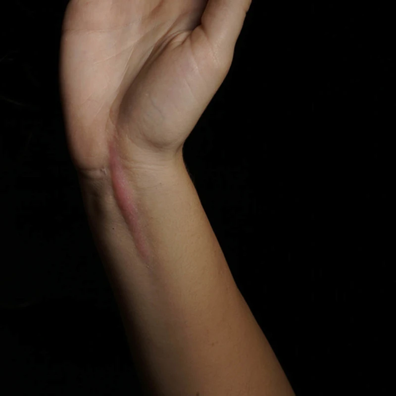 PROTESI SET CICATRICI CHELOIDI 3 PROTESI SET CICATRICI CHELOIDI - immagine 3